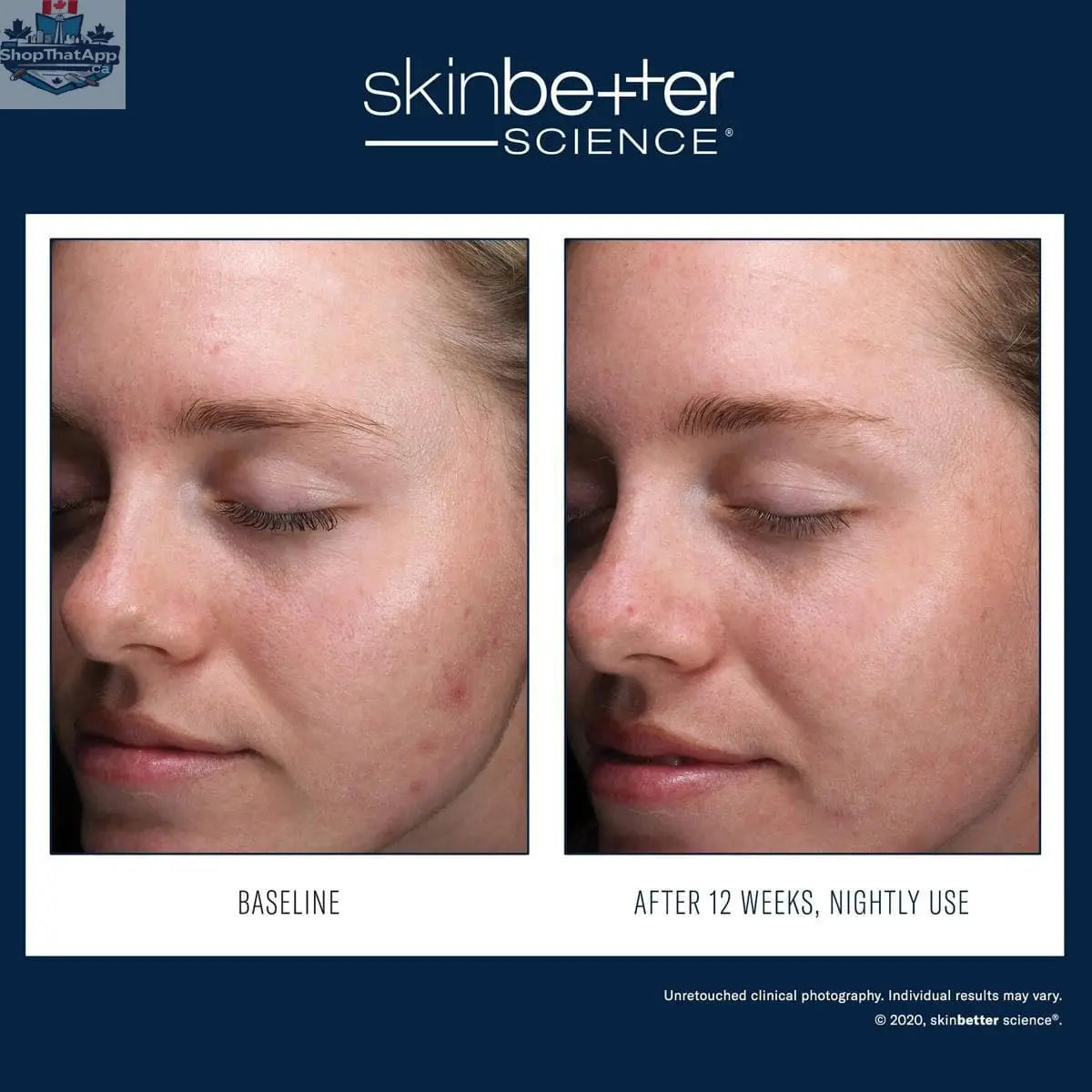Skinbetter Science AlphaRet Clearing Serum in a sleek bottle, designed for clear, smooth skin with retinol and exfoliating ingredients.