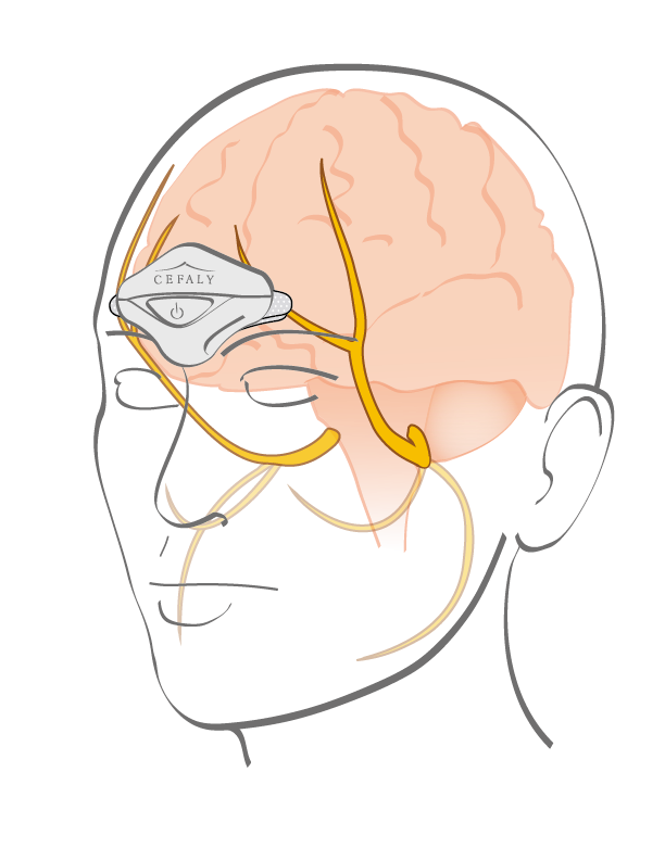 CEFALY® Electrodes--www.Shopthatapp.ca-BHR Biosynex