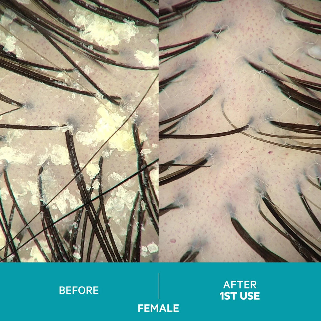 Dandrene Exfoliating Anti-Dandruff Shampoo - Shopthatapp.ca