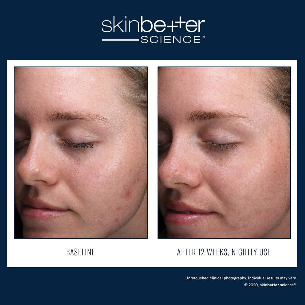 Skinbetter Science - AlphaRet Clearing Serum - Shopthatapp.ca